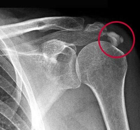 X-rays show deposits of calcium salts in the joints
