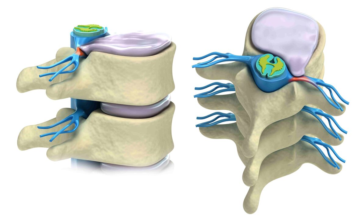 spinal disc is damaged