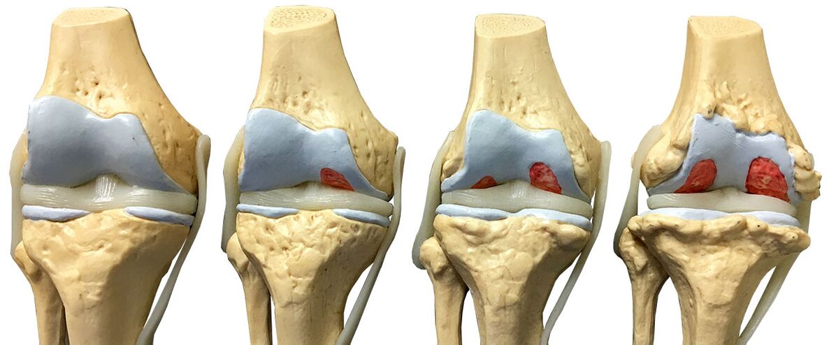 Stage of arthrosis of the knee joint