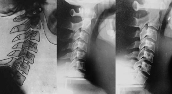 Neck with first displacement of cervical vertebrae
